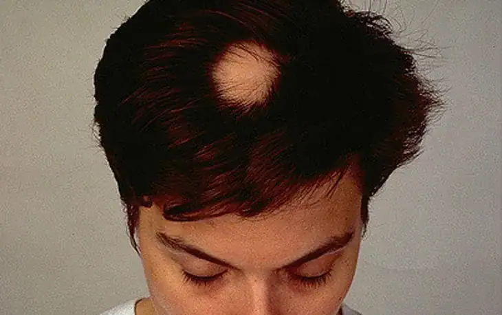Boy’s hair starts to fall out, but then mom learns how classmates secretly plotted behind his back