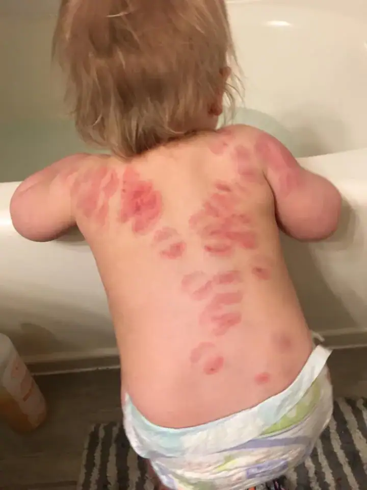 Mom discovers 25 bite marks on baby daughter after picking her up from daycare