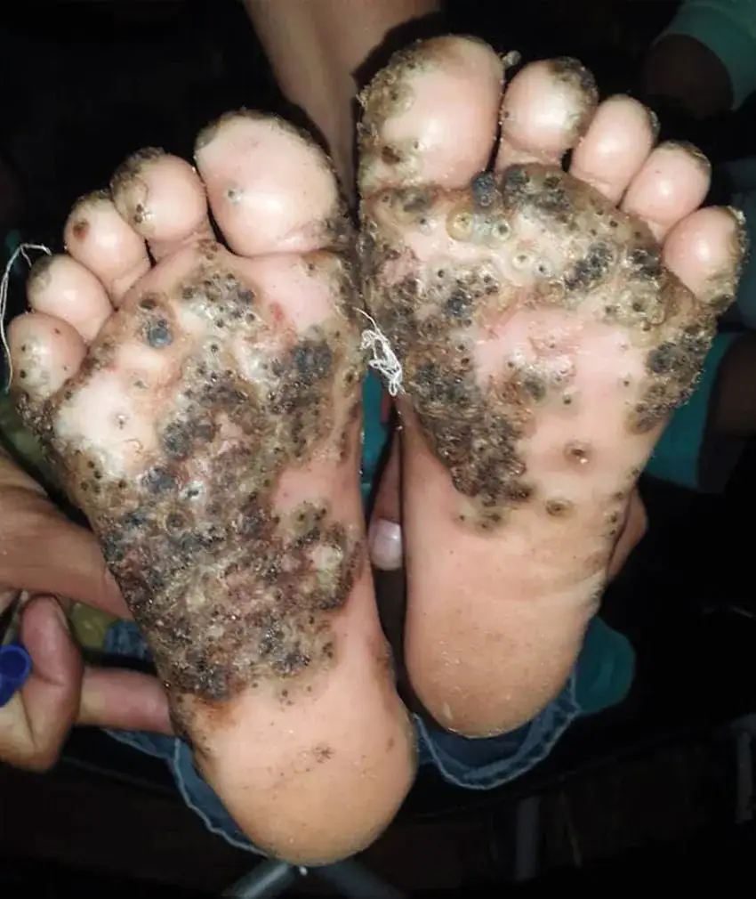 10-year-old girl’s feet infested with fleas after she ran through pigsty barefoot