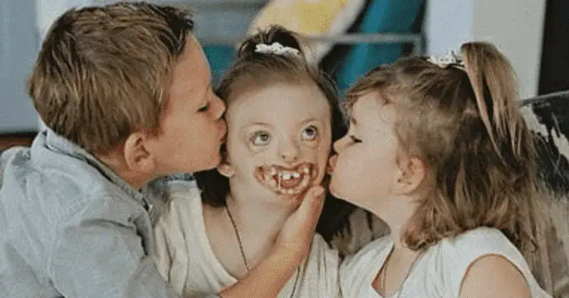Disabled girl bullied for her facial deformities has passed away at age 10