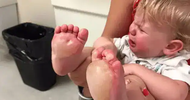 Mom finds large blisters on her baby’s feet, days later police unravel disturbing truth