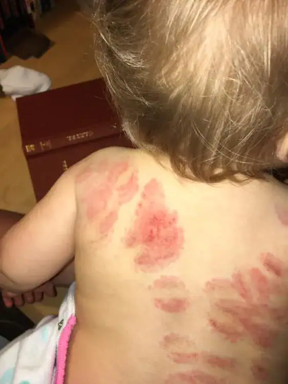 Mom discovers 25 bite marks on baby daughter after picking her up from daycare