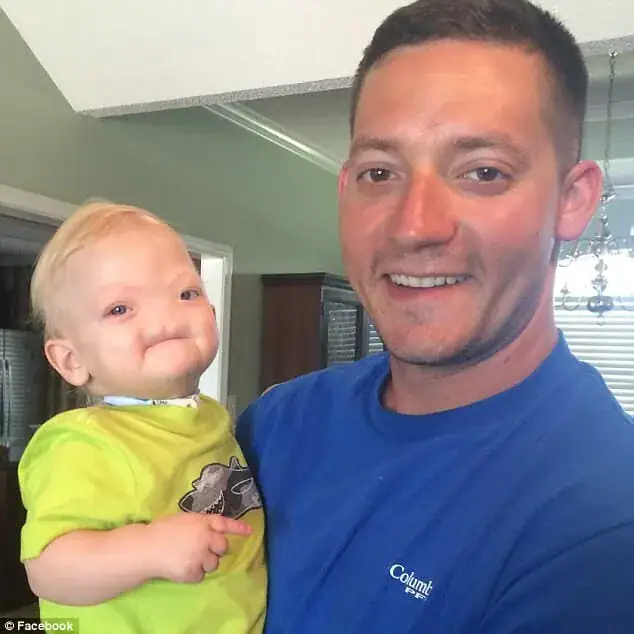Tragedy as ‘Miracle baby’ born without a nose passes away at age two