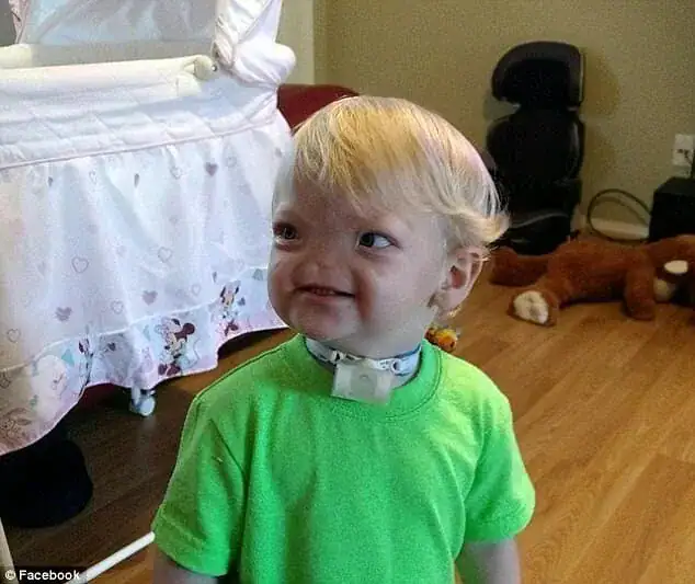 Tragedy as ‘Miracle baby’ born without a nose passes away at age two
