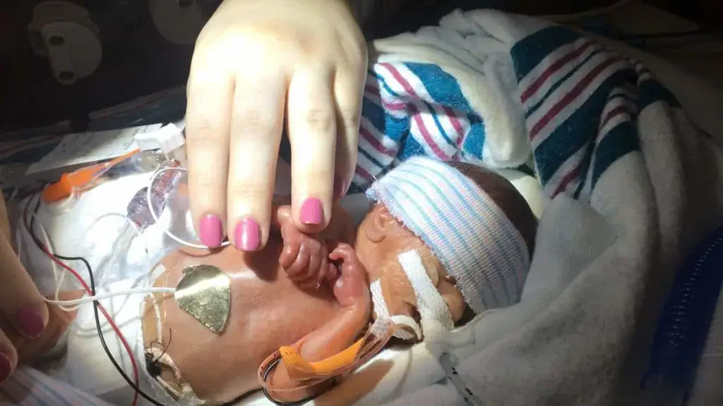 Baby born 16 weeks premature weighing only a pound just celebrated her first birthday