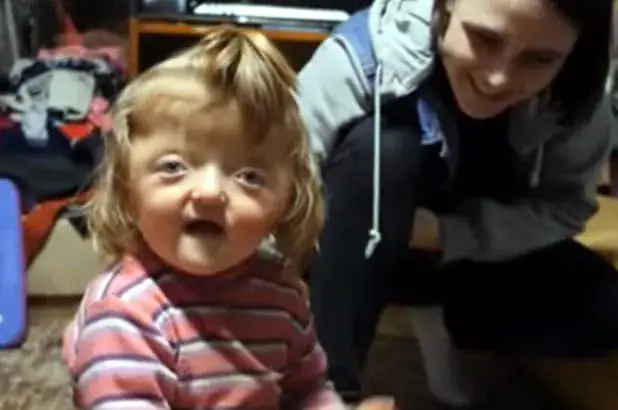 2-year-old banned from nursery because her deformed skull is too scary