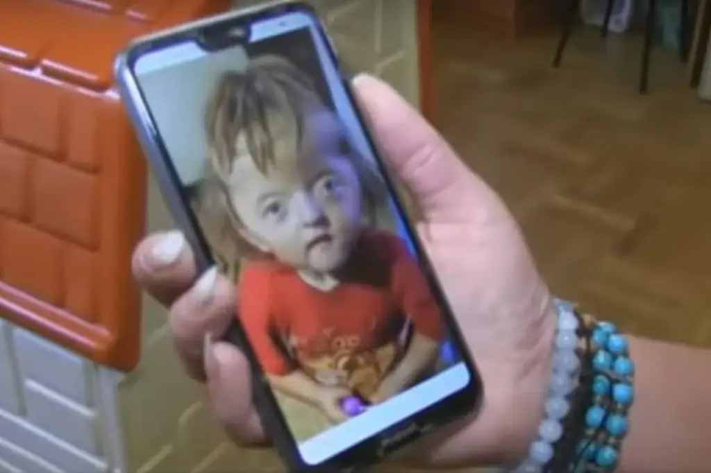 2-year-old banned from nursery because her deformed skull is too scary