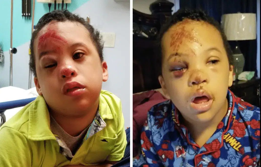 Family livid after school refuses to share video showing how age 7 son with Down syndrome was injured on bus