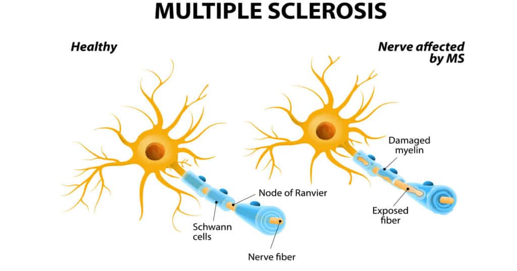Scientist breakthrough: we are on the verge of curing Multiple Sclerosis for 2.3 million people