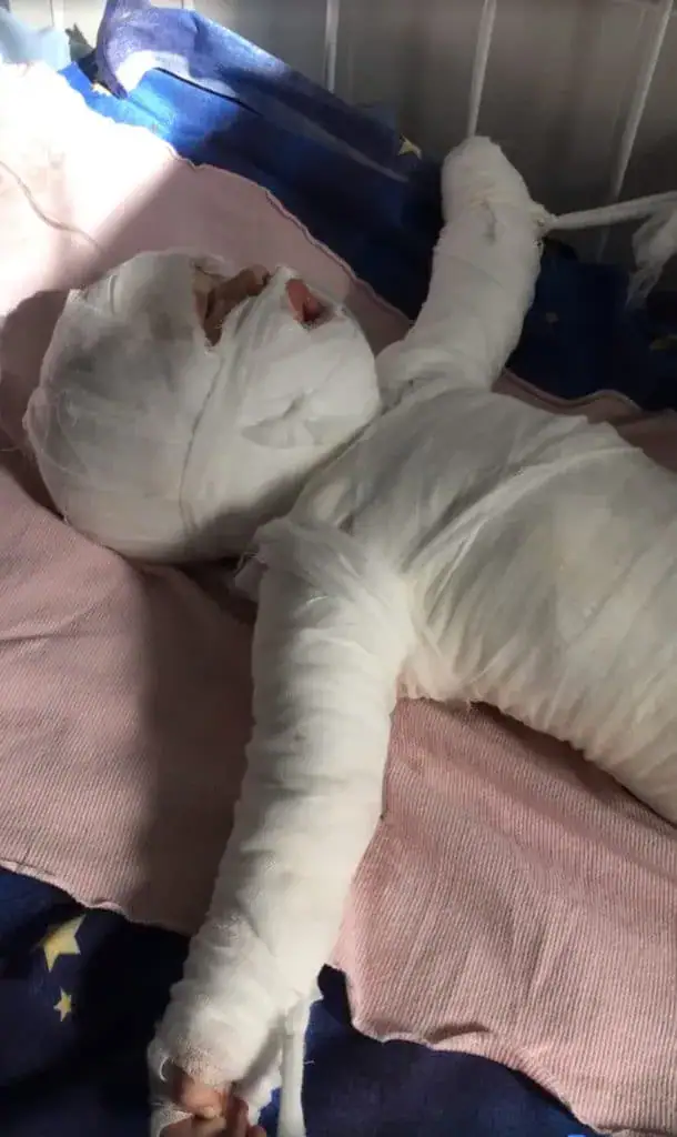 11-month-old boy who was ‘clinging onto life’ after falling into boiling water has died