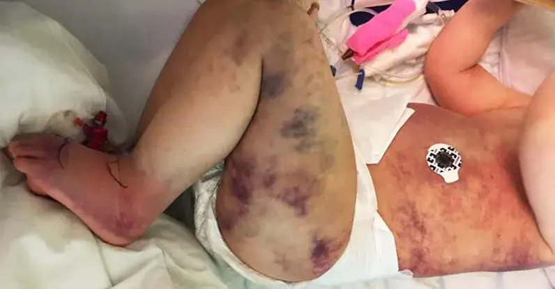 Mom wrongly thinks 3-year-old son got stung by a wasp – then his little body turns blue