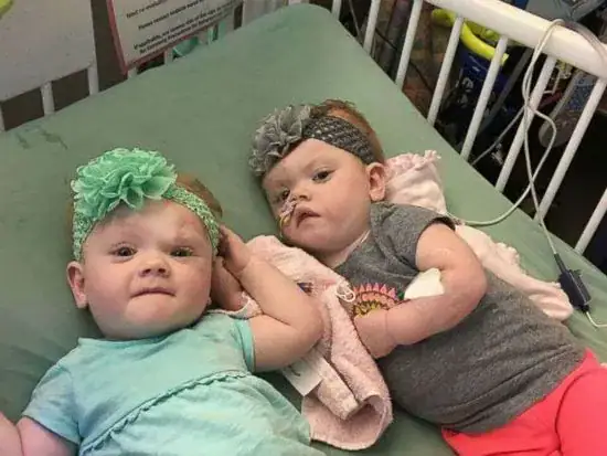 One year after their separation, conjoined twins are celebrating their new lives – wish them well
