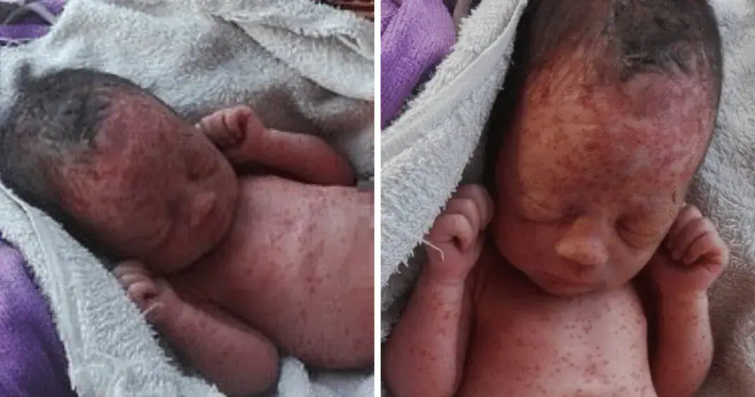 Update on newborn girl found covered in bug bites after being dumped in a field