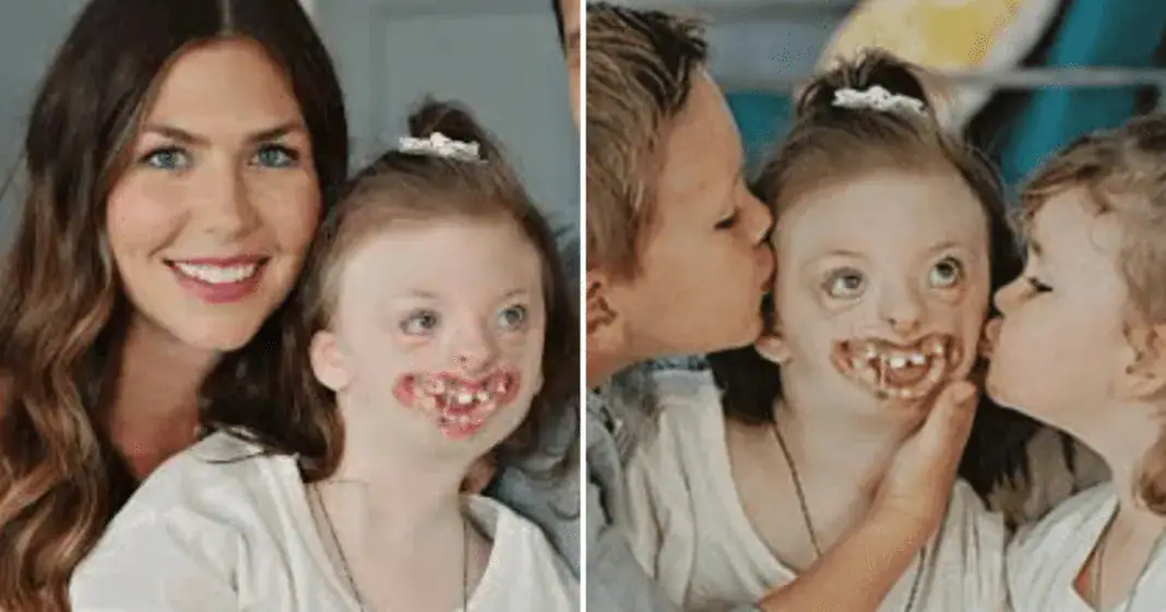 Disabled girl bullied for her facial deformities has passed away at age 10