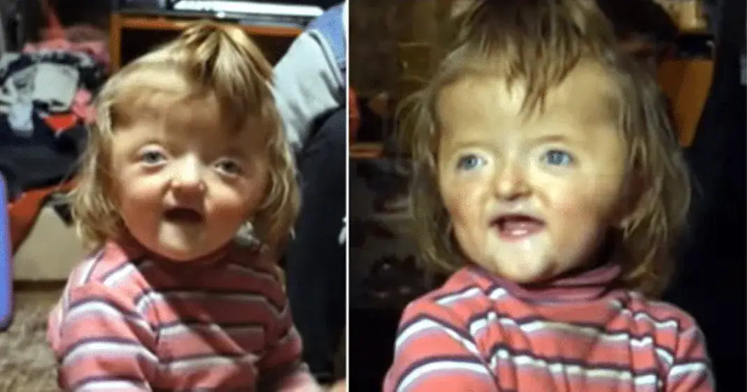 2-year-old banned from nursery because her deformed skull is too scary