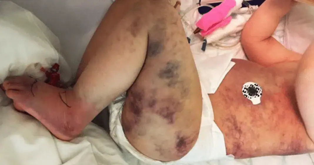 Mom wrongly thinks 3-year-old son got stung by a wasp – then his little body turns blue