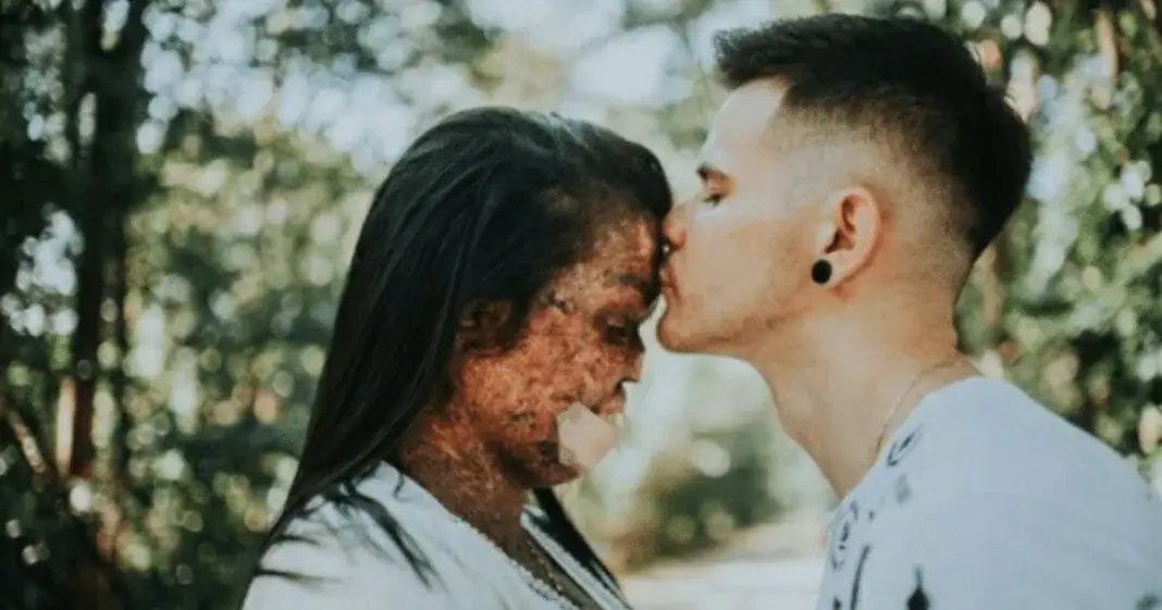 Man gets engaged to a woman with incurable skin disease and inspires millions