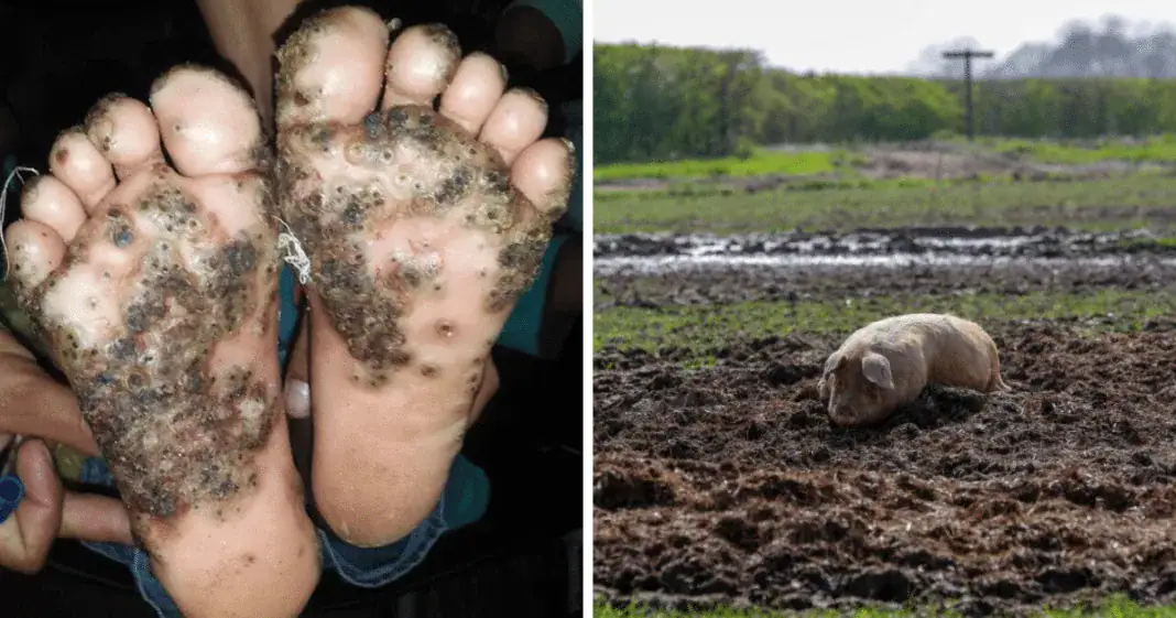 10-year-old girl’s feet infested with fleas after she ran through pigsty barefoot
