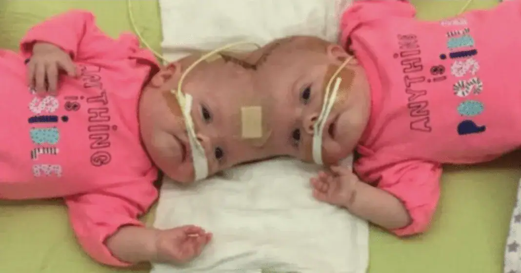 One year after their separation, conjoined twins are celebrating their new lives – wish them well