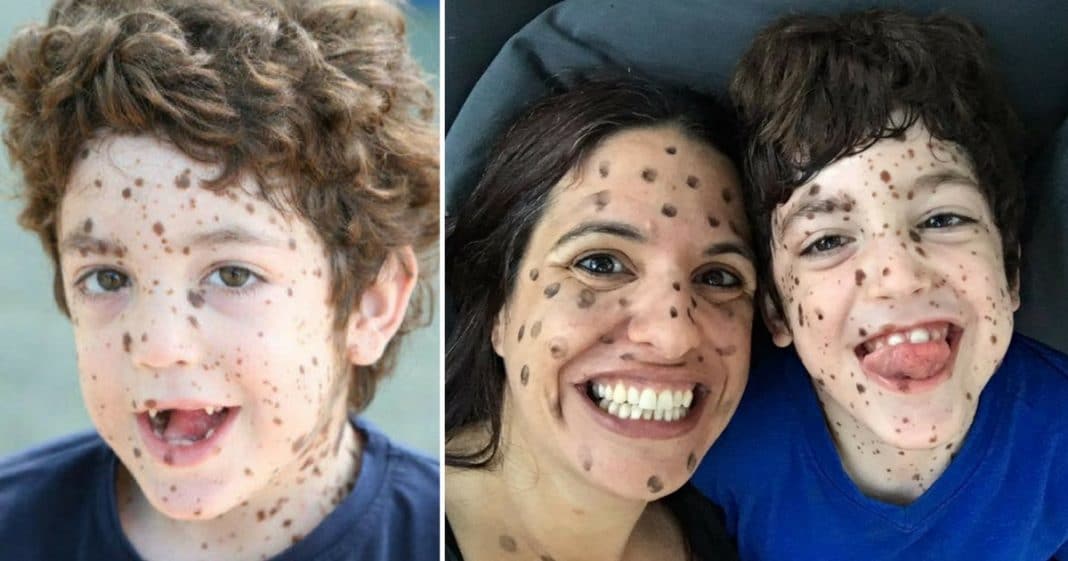 Mom And Daughter Mock Boy With Spots All Over. His Response Silences Them For Good