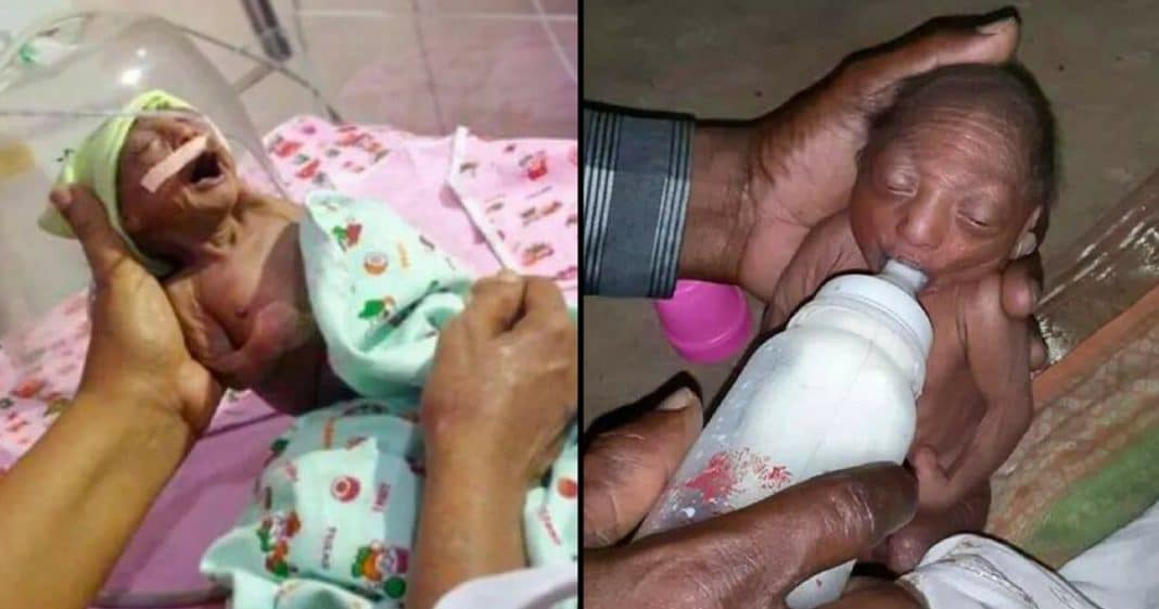 Mom Rejects Baby With Skin Like Old Woman, But Grandpa Gives Her A Second Chance