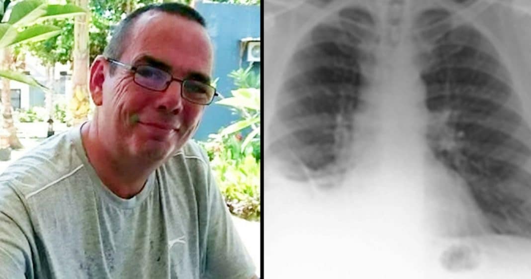Doctors Think Man Has Lung Cancer, Jaws Drop When They See What ‘Tumor’ Really Is