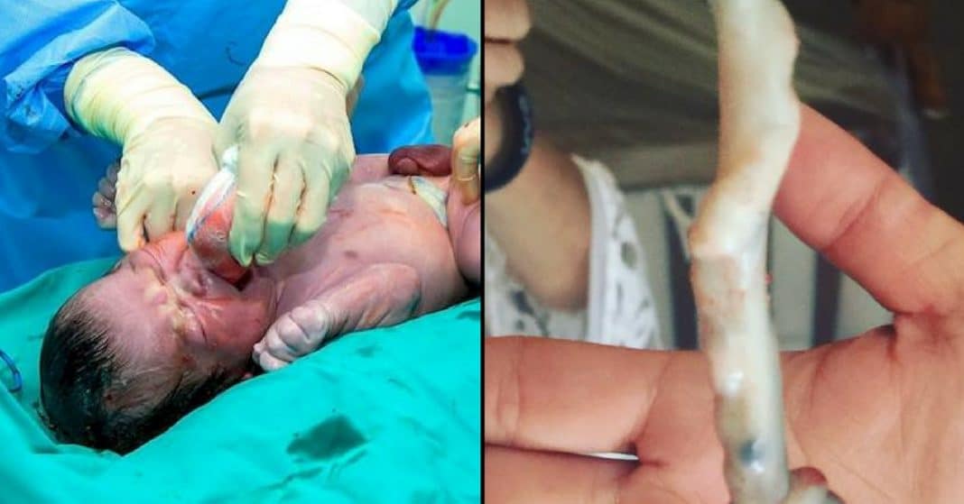 Doctor Delivers Healthy Baby Then Takes 1 Look At Umbilical Cord, Tells Dad It’s A Miracle