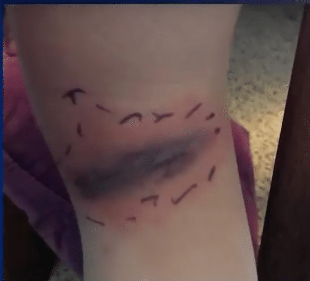The spider bite on Kailyn's leg