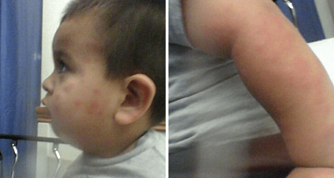 Age 3 Boy Wakes Up With Awful Rash All Over Body, Then Doctors Tell Mom Horrifying Truth
