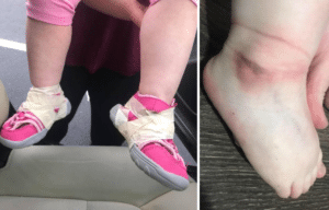 Child's feet with tape