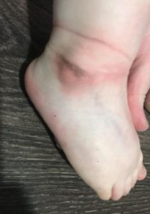 The child's ankle shows irritation and swelling