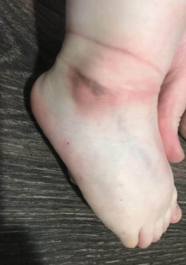 The child's ankle shows irritation and swelling