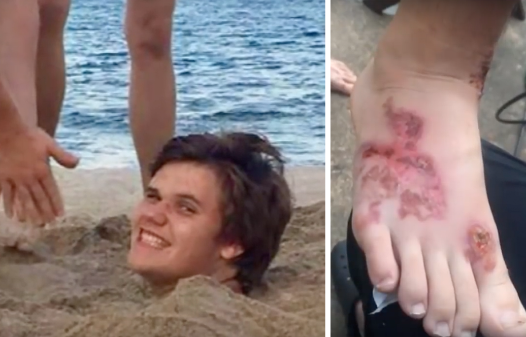 Trip To The Beach Turns Into Nightmare For Teen After He’s Left With Permanent Scars On His Body