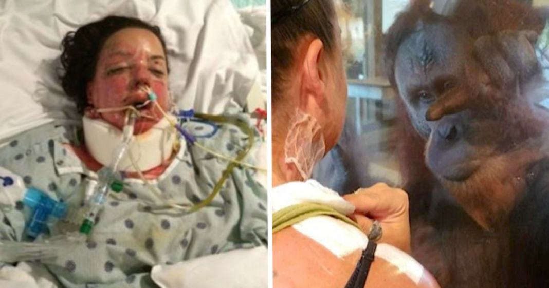 Orangutan asks burn survivor to peel back bandages – everyone’s baffled by reaction to her scars