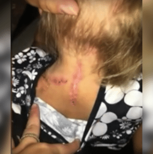 The injury to Jaclyn's neck and shoulder