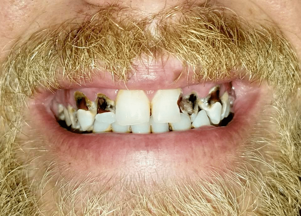 Moore's teeth before the visit to Dr. Wilstead