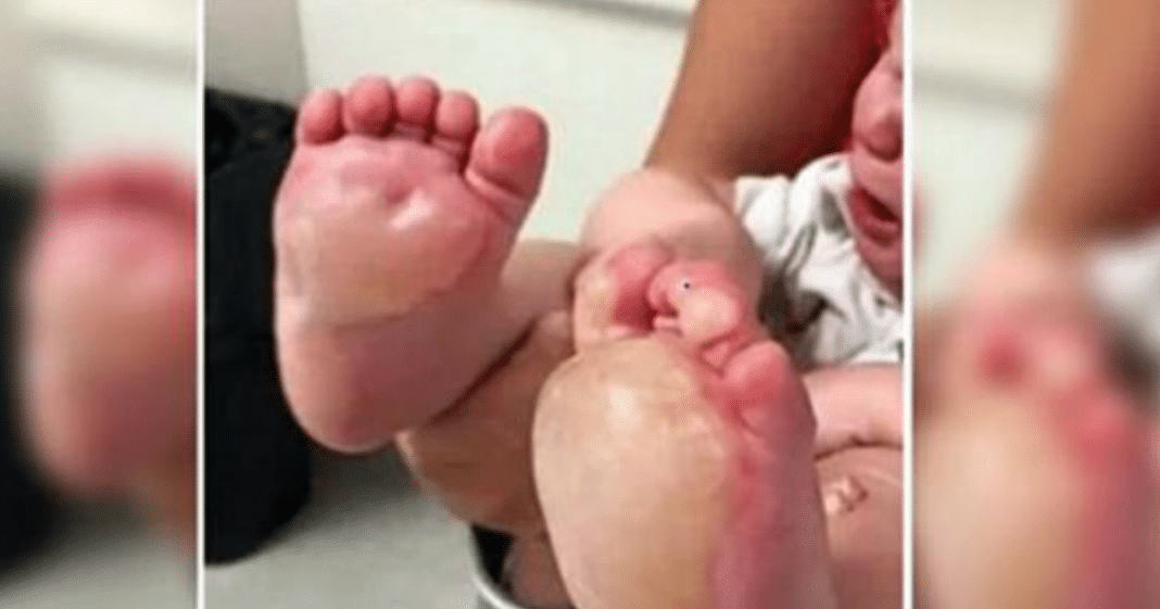 Mom finds large blisters on her baby’s feet, days later police unravel disturbing truth
