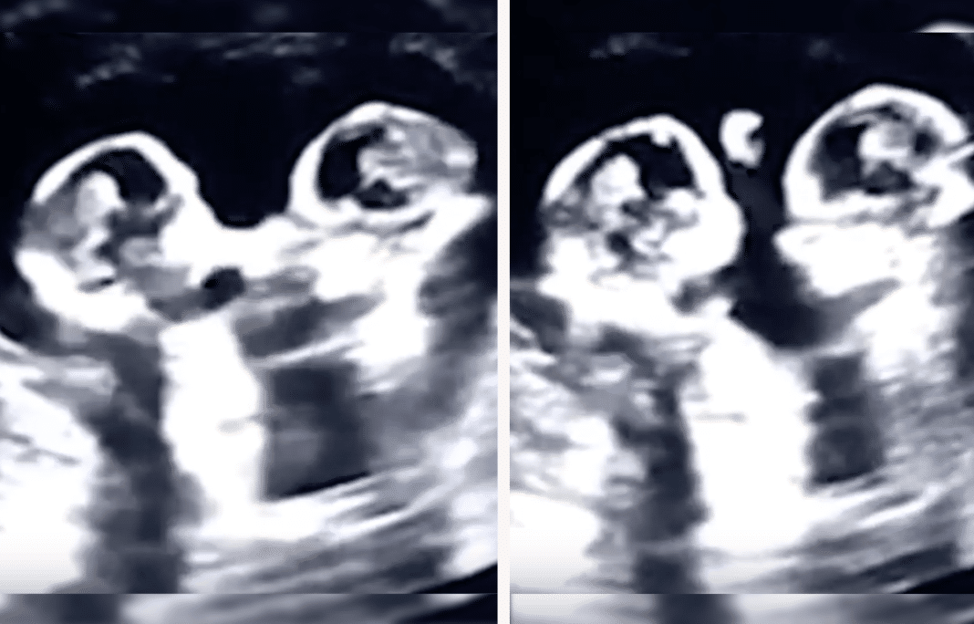 Identical twin sisters are spotted ‘fighting’ with each other in their mother’s womb
