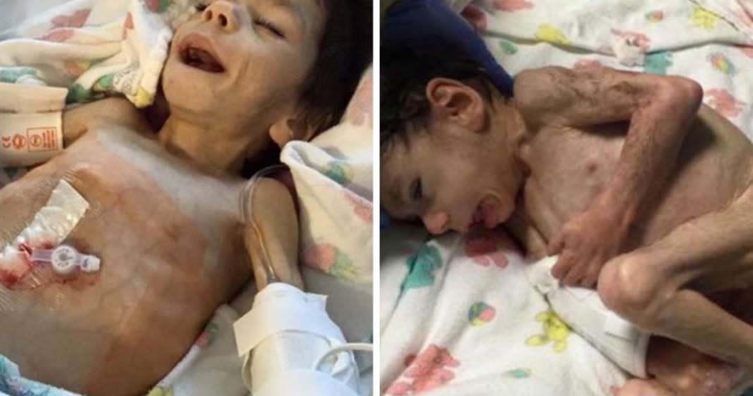 Starving 6-year-old orphan weighed only 8 pounds – but now looks unrecognizable
