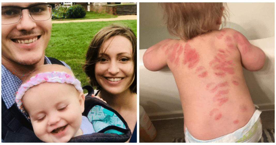 Mom discovers 25 bite marks on baby daughter after picking her up from daycare